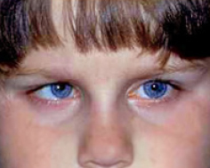 Four-year old girl with accommodative esotropia.