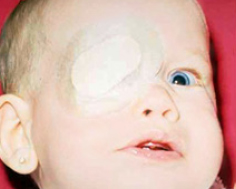 Eye patch worn over this child's right eye to reverse amblyopia in the left eye.