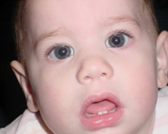 Young child treated for esotropia.