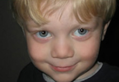 Child with albinism demonstrating chin-down posture.