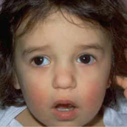 Child with Exotropia.