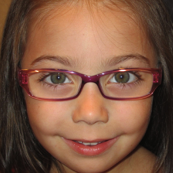 Child with Accommodative Esotropia.