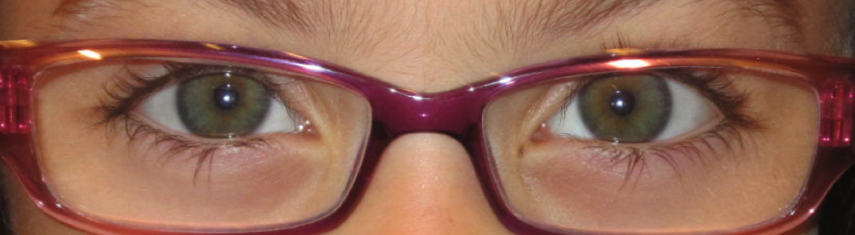 After-Accommodative Esotropia