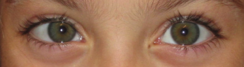 Before-Accommodative Esotropia