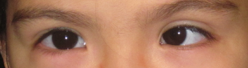 Before-Accommodative Esotropia