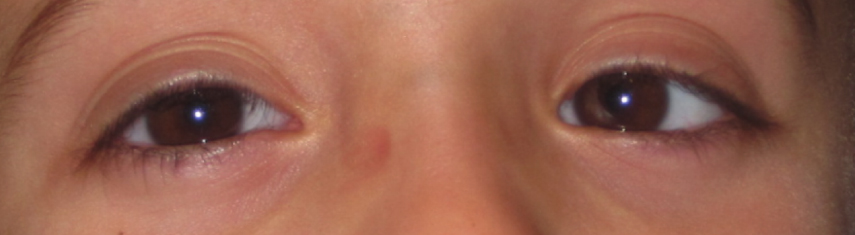 Before-Accommodative Esotropia