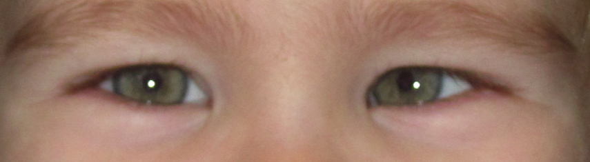 Before-Accommodative Esotropia