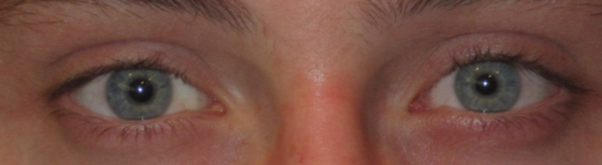 After-Adult Strabismus