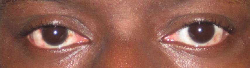 After-Exotropia