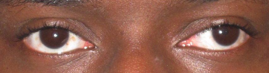 Before-Exotropia