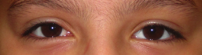 After-Exotropia