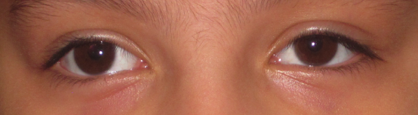 Before-Exotropia