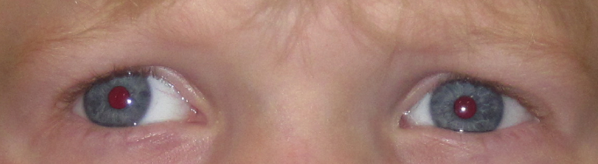 Before-Exotropia