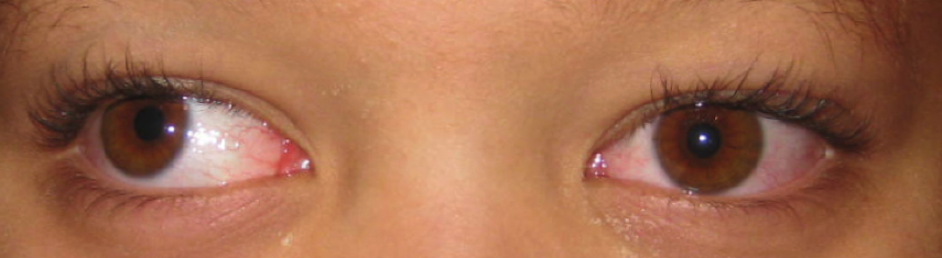 Before-Exotropia