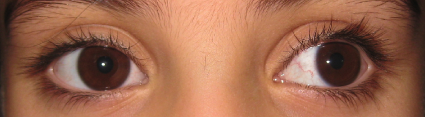 Before-Exotropia