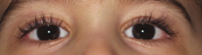 After-Exotropia