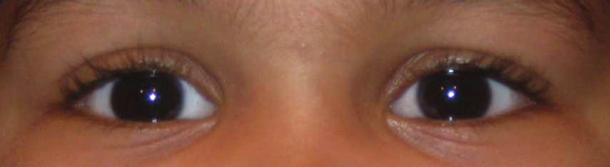 After-Exotropia