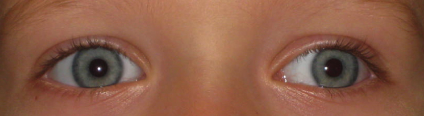 Before-Exotropia